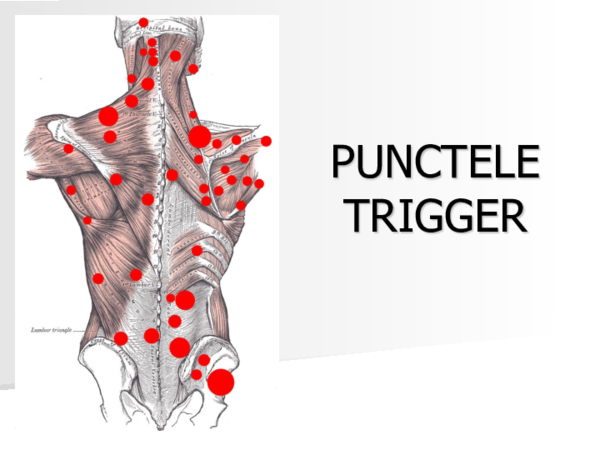 (PDF) Trigger Points