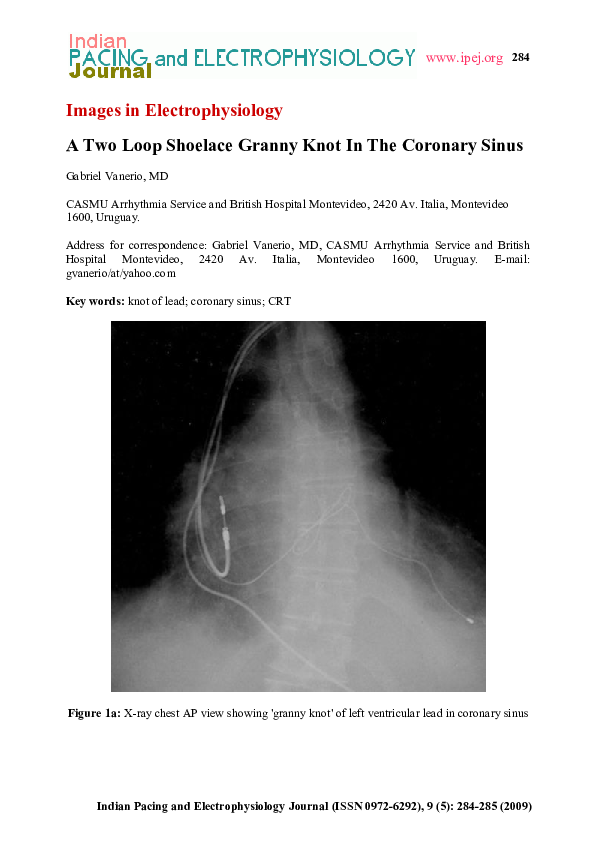(PDF) A two loop shoelace granny knot in the coronary sinus Gabriel