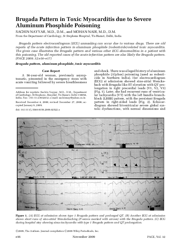 (PDF) Brugada Pattern in Toxic Myocarditis due to Severe Aluminum