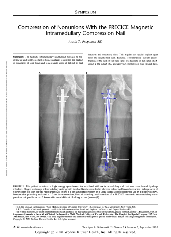 (PDF) Compression of Nonunions With the PRECICE Magnetic Intramedullary ...