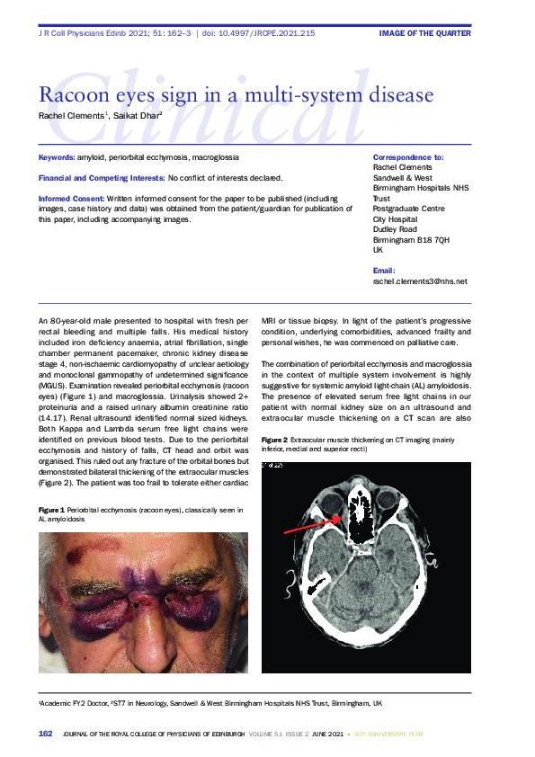 (PDF) Racoon eyes sign in a multi-system disease | Saikat Dhar ...