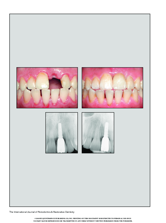 (PDF) Clinical and Radiographic Evaluation of Early Loaded Maxillary ...