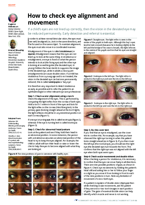 (PDF) How to check eye alignment and movement Anand Moodley