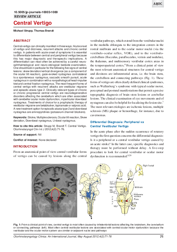 (PDF) Central Vertigo