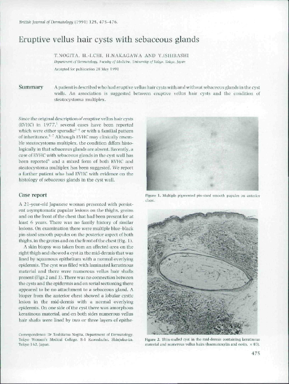 How To Get Rid Of Eruptive Vellus Hair Cysts (PDF) Eruptive vellus hair cysts with sebaceous glands | Toshitatsu