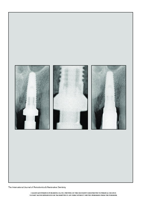 (PDF) A 4-Year Retrospective Radiographic Study of Marginal Bone Loss ...