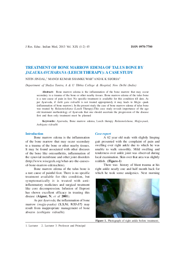 (PDF) Treatment of Bone Marrow Edema of Talus Bone Byjalaukaavcharana (Leech Therapy) A Case