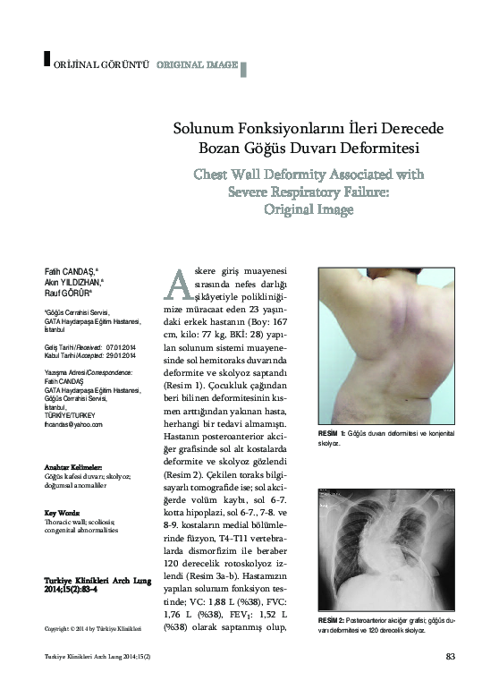 (PDF) Solunum Fonksiyonlarını İleri Derecede Bozan Göğüs Duvarı (PDF) Solunum Fonksiyonlarını İleri Derecede Bozan Göğüs Duvarı
