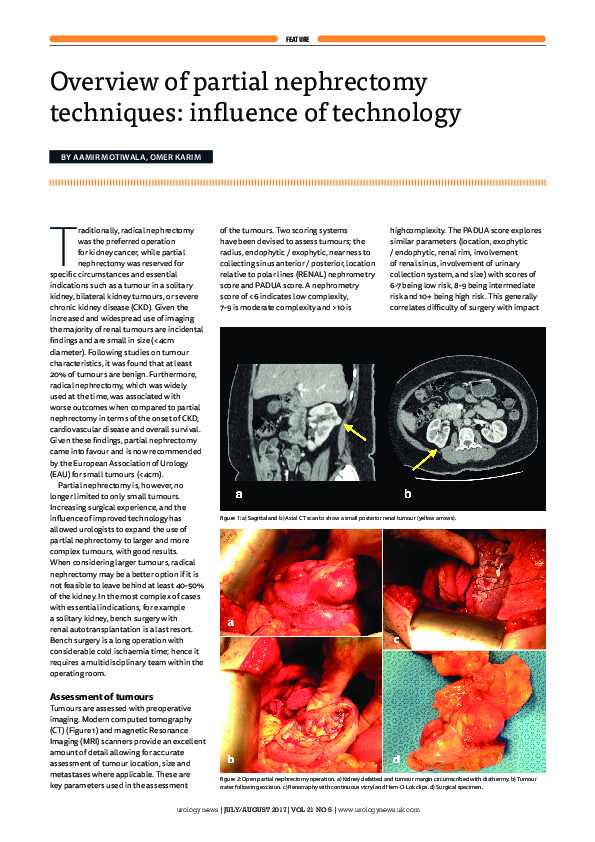 (PDF) Overview of partial nephrectomy techniques : influence of technology