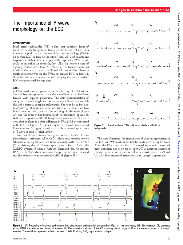 (PDF) The importance of P wave morphology on the ECG