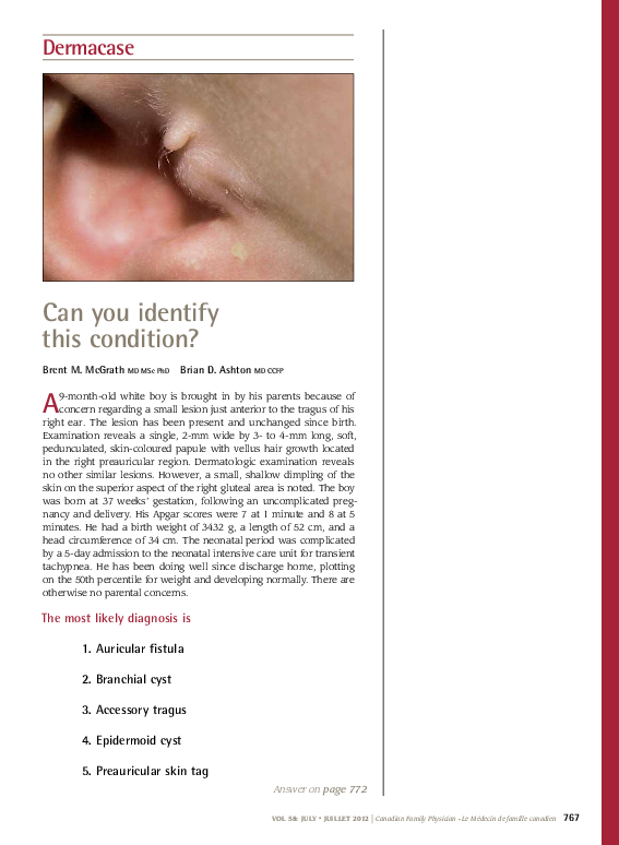 (PDF) Dermacase Can you identify this condition? Accessory tragus