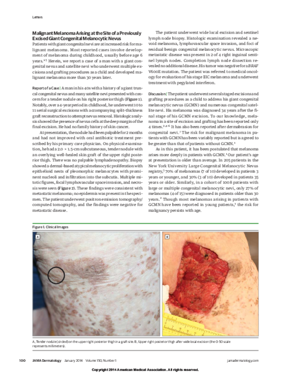 (PDF) Malignant Melanoma Arising at the Site of a Previously Excised ...