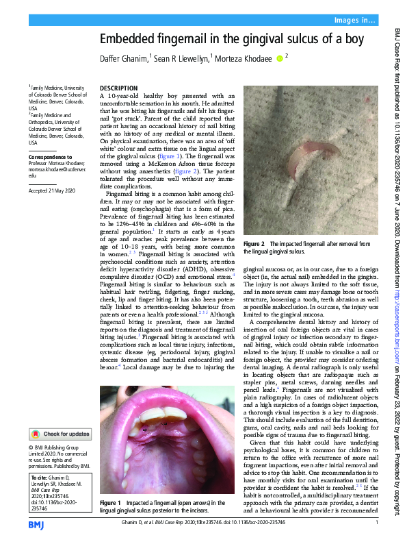 (PDF) Embedded fingernail in the gingival sulcus of a boy