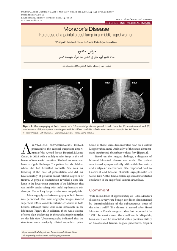 (PDF) Mondor's Disease Rare case of a painful breast lump in a middle