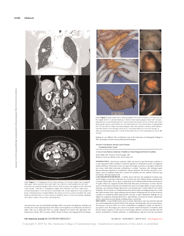 (PDF) A Case of AutoBrewery Syndrome Probably an UnderDiagnosed Medical Condition Fahad