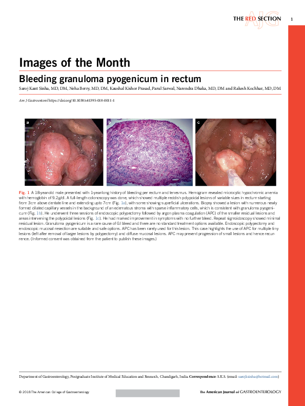 (PDF) Bleeding granuloma pyogenicum in rectum Rakesh Kochhar