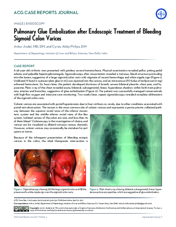 (PDF) Pulmonary Glue Embolization after Endoscopic Treatment of ...