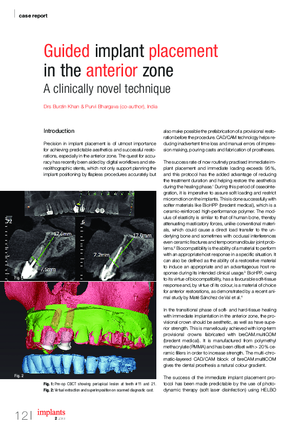 (PDF) Guided implant placement in the anterior zone A clinically novel ...