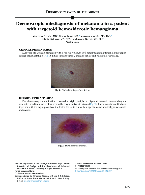 (PDF) Dermoscopic misdiagnosis of melanoma in a patient with targetoid ...