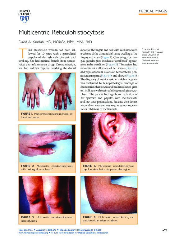 (PDF) Multicentric Reticulohistiocytosis