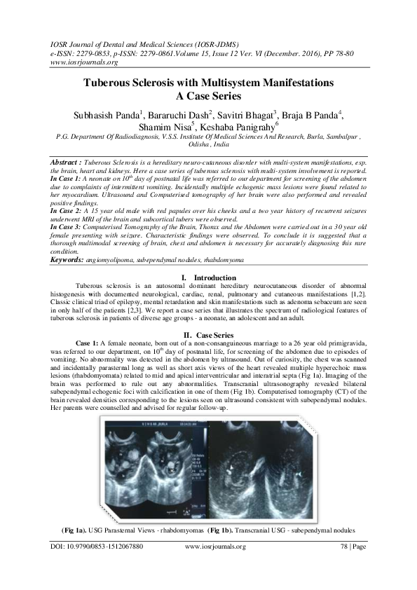 (PDF) Tuberous Sclerosis with Multisystem Manifestations A Case Series