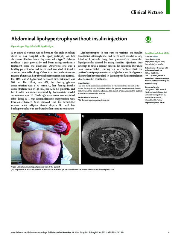 (PDF) Abdominal lipohypertrophy without insulin injection Kagan