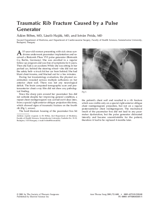 (PDF) Traumatic rib fracture caused by a pulse generator
