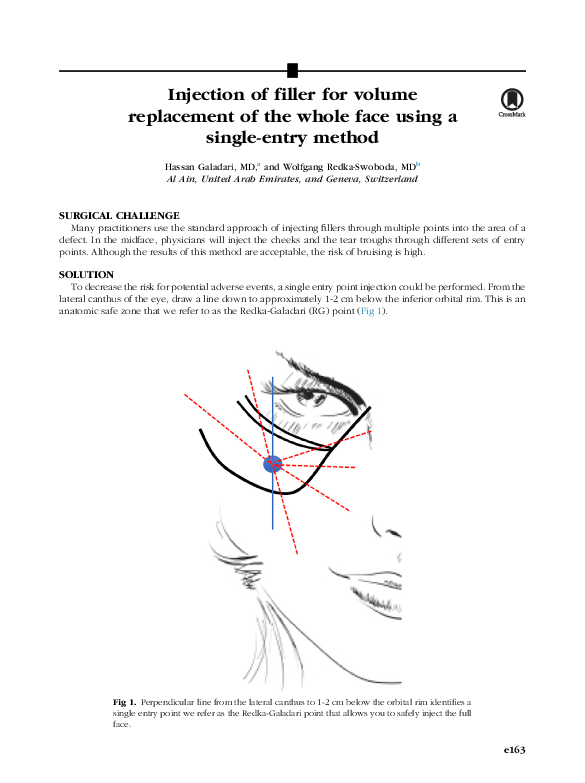 (PDF) Injection of filler for volume replacement of the whole face ...