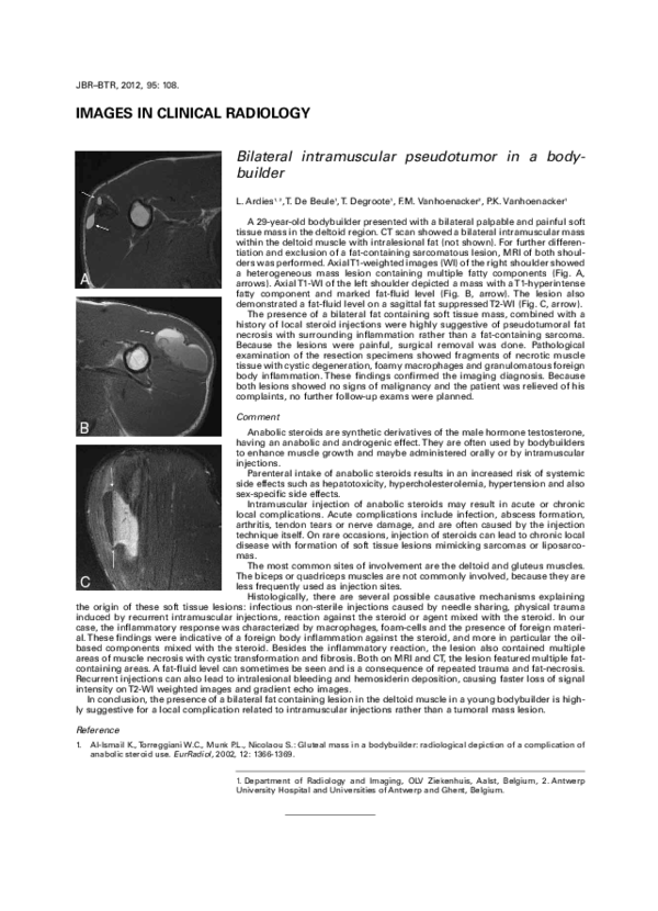 (PDF) Bilateral intramuscular pseudotumor in a body-builder