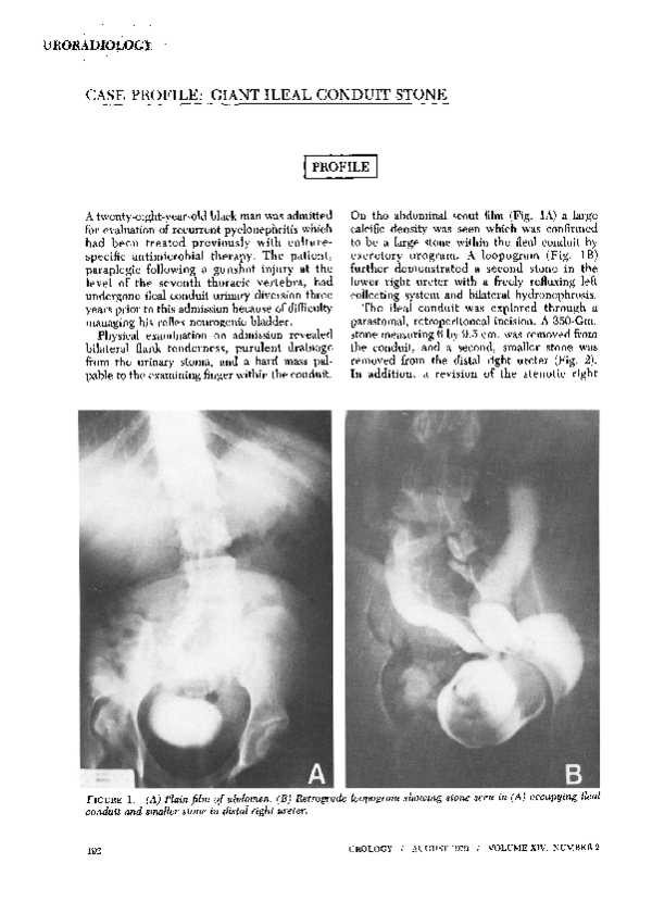 (PDF) Case profile giant ileal conduit stone Walter Goycochea