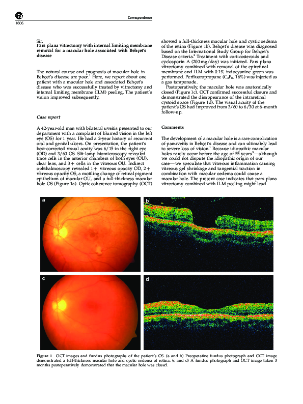 (PDF) Pars plana vitrectomy with internal limiting membrane removal for ...