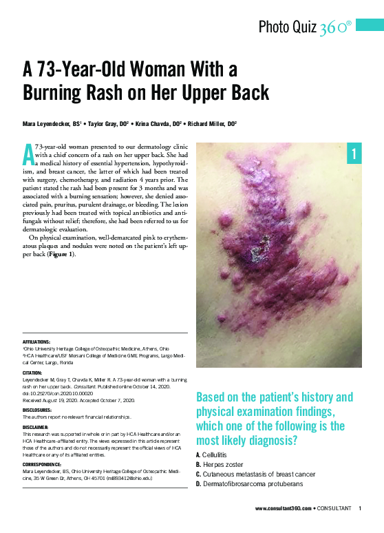 (PDF) A 73-Year-Old Woman With a Burning Rash on Her Upper Back