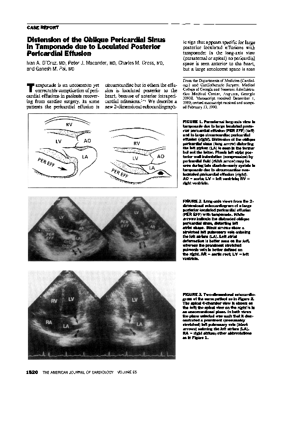 (PDF) Distension of the oblique pericardial sinus in tamponade due to ...