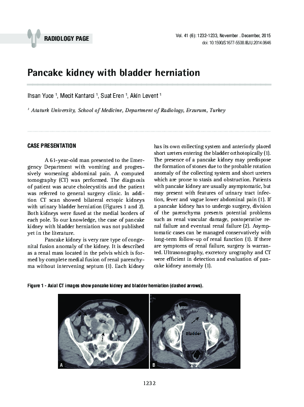 (PDF) Pancake kidney with bladder herniation Suat Eren Academia.edu