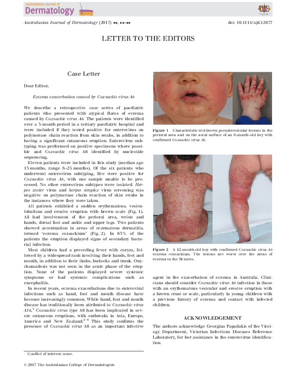 (PDF) Eczema exacerbation caused by Coxsackie virus A6 Laura Scardamaglia Academia.edu