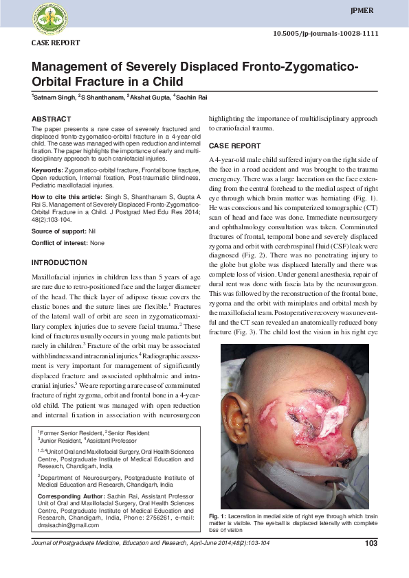 (PDF) Management of Severely Displaced Fronto-Zygomatico-Orbital ...