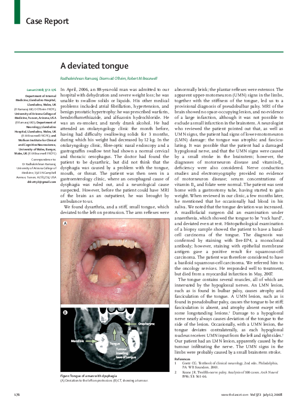 (PDF) A deviated tongue