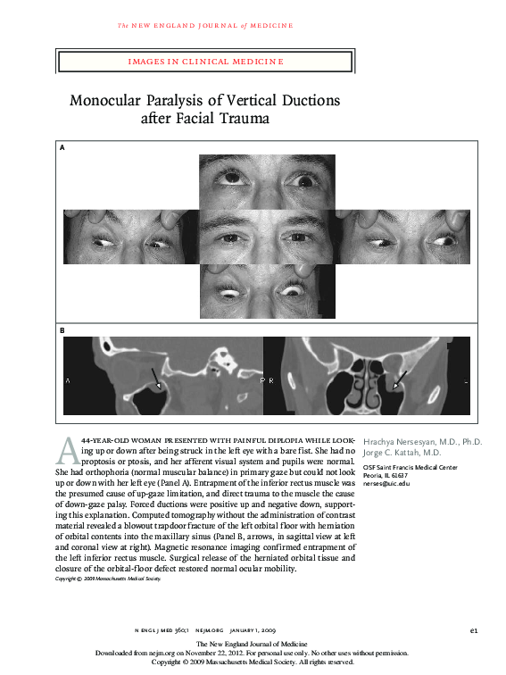 (PDF) Monocular Paralysis of Vertical Ductions after Facial Trauma ...