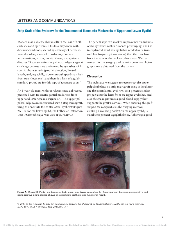 (PDF) Strip Graft of the Eyebrow for the Treatment of Traumatic