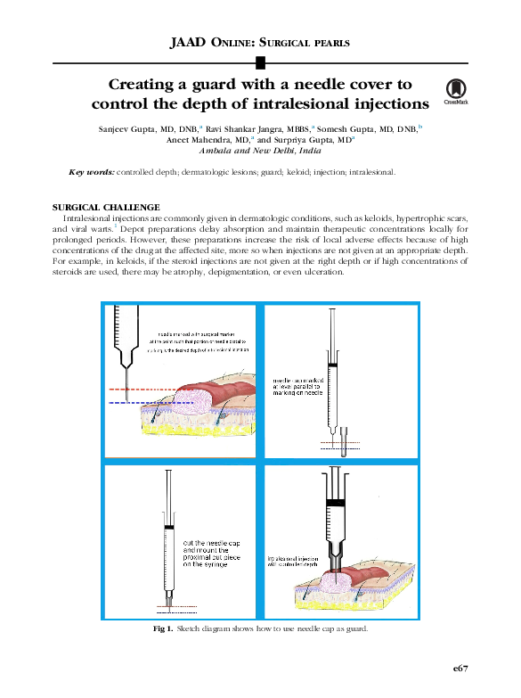 (PDF) Creating a guard with a needle cover to control the depth of ...
