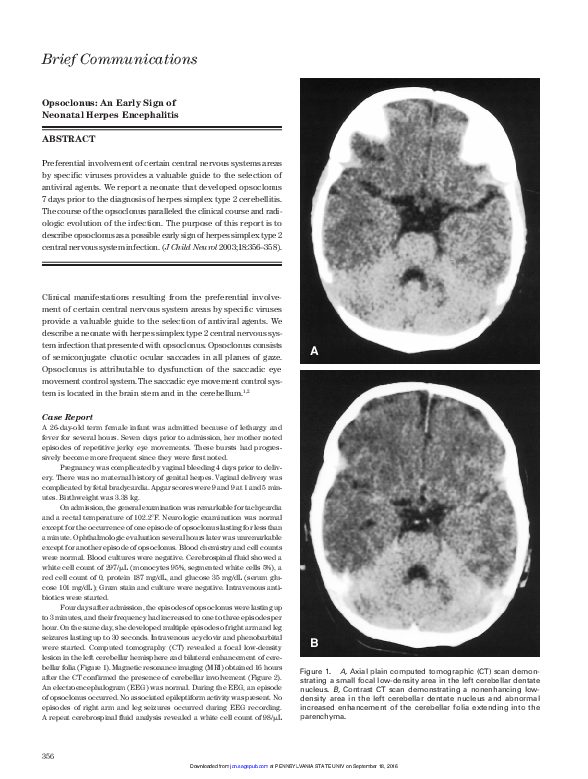 (PDF) Opsoclonus: An Early Sign of Neonatal Herpes Encephalitis