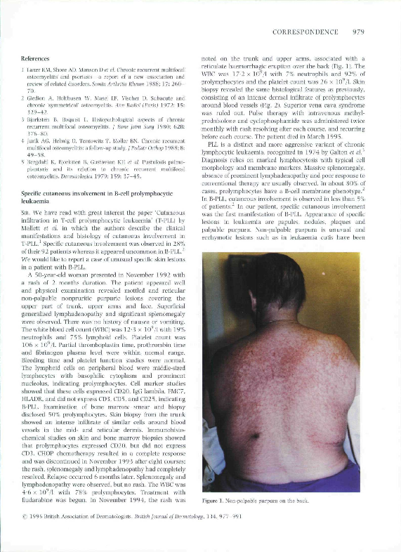 (PDF) Specific cutaneous involvement in B-cell prolymphocytic leukaemia