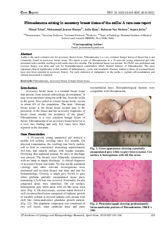 (PDF) Fibroadenoma arising in accessory breast tissue of the axilla: A ...