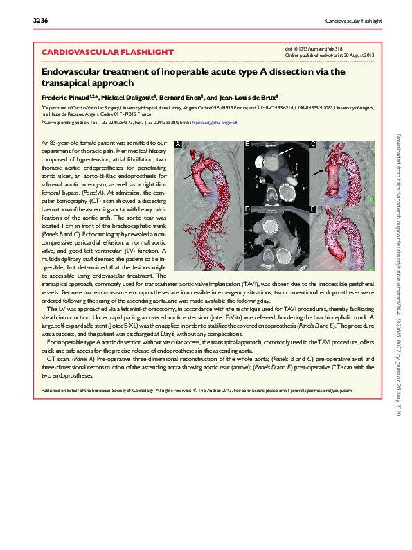 (PDF) Endovascular treatment of inoperable acute type A dissection via ...