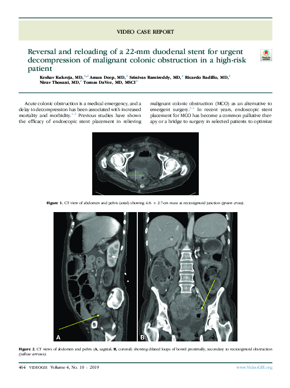 (PDF) Reversal and reloading of a 22-mm duodenal stent for urgent ...