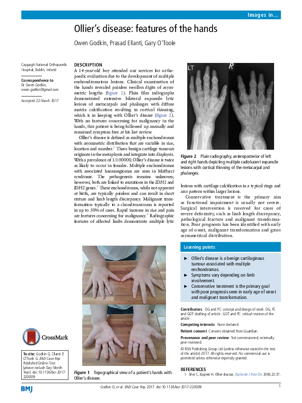 (PDF) Ollier’s disease: features of the hands