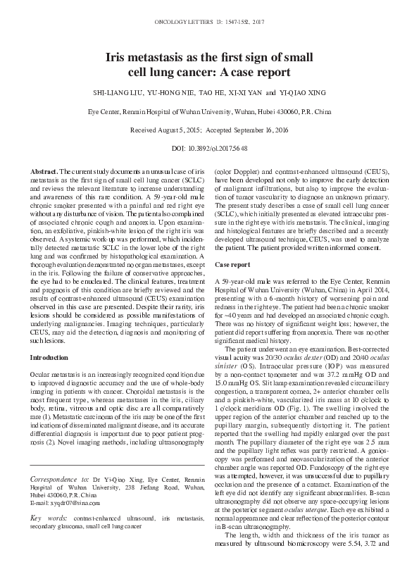 (PDF) Iris metastasis as the first sign of small cell lung cancer: A ...