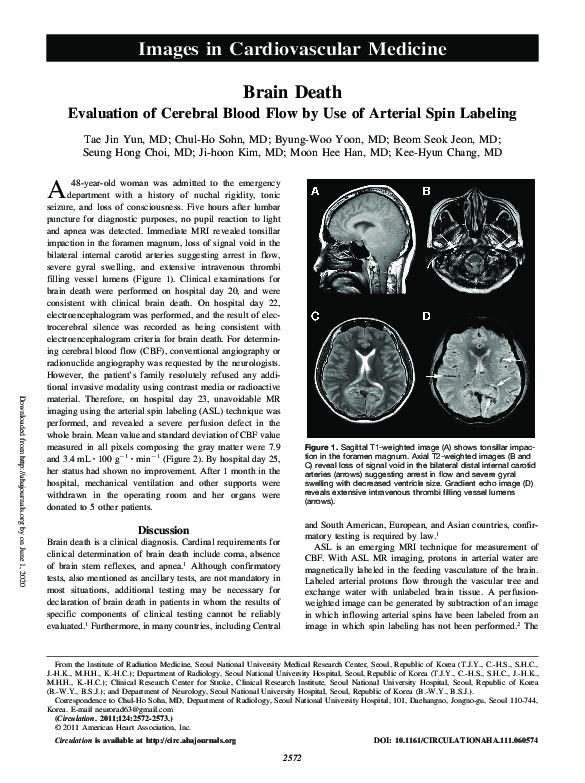 (PDF) Brain Death: Evaluation of Cerebral Blood Flow by Use of Arterial ...