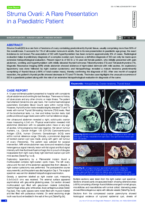 (PDF) Struma Ovarii: A Rare Presentation in a Paediatric Patient