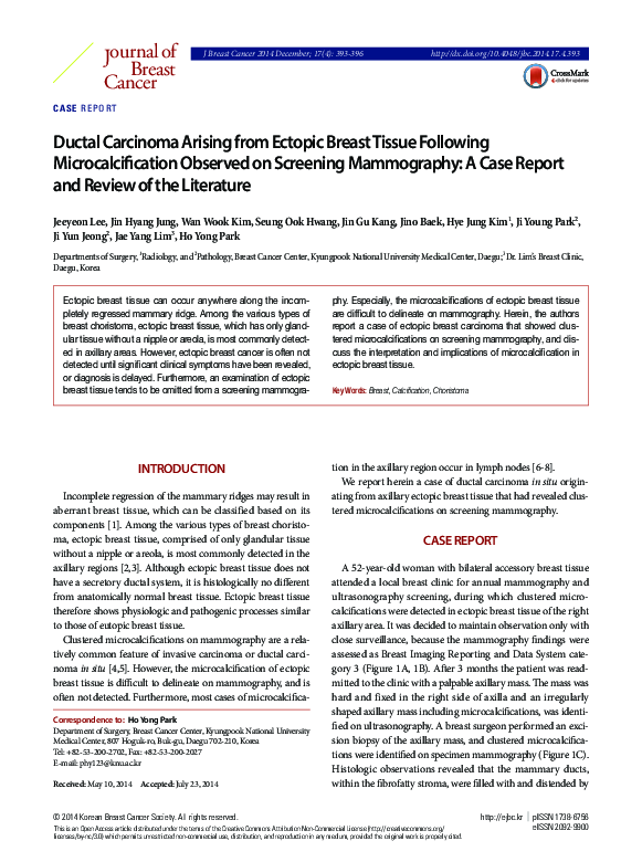 (PDF) Ductal carcinoma arising from ectopic breast tissue following ...